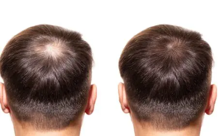 Protecting Transplanted Hair from Dry Air, Dandruff, and Static in Winter