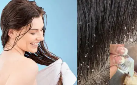 Troubled By Dandruff And Itching? Add These 4 Ingredients To Your Shampoo For Healthy Hair