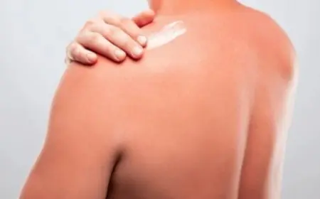 What Is Sunburn? Latest Study Brings Out Surprising Details