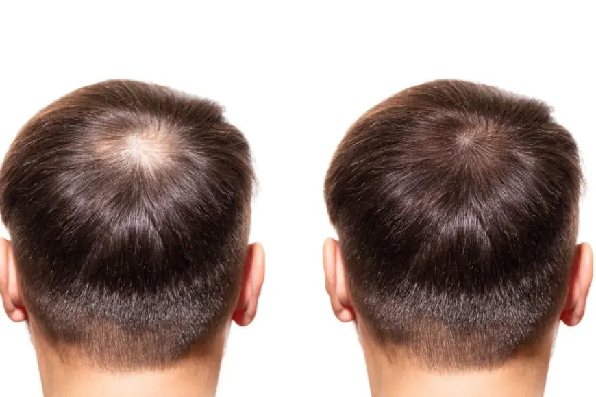 Protecting Transplanted Hair from Dry Air, Dandruff, and Static in Winter