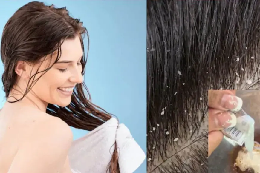 Troubled By Dandruff And Itching? Add These 4 Ingredients To Your Shampoo For Healthy Hair