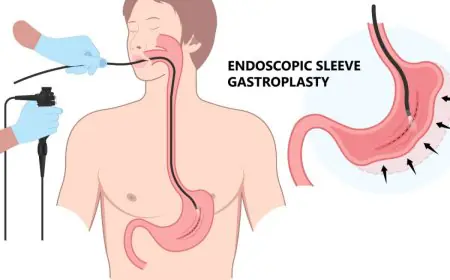 Beyond Diets and Gym Memberships: Why Minimally Invasive Procedure Are Changing Obesity Treatment?