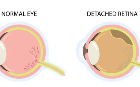Understanding Retinal Detachment: Early Symptoms, Causes, and Treatment Options