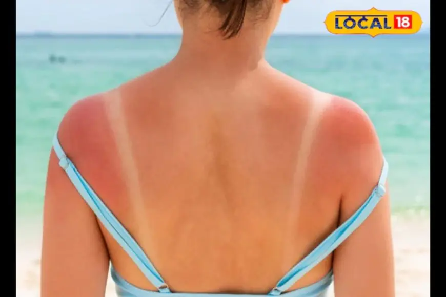 As Mercury Rises, Try These Effective Home Remedies To Remove Tan At Home
