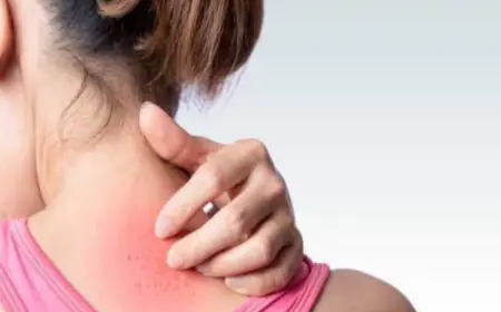 Instead Of Ice, Use These Simple Remedies To Treat Summer Body Rashes