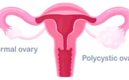 The Connection Between PCOS and Thyroid Disorders