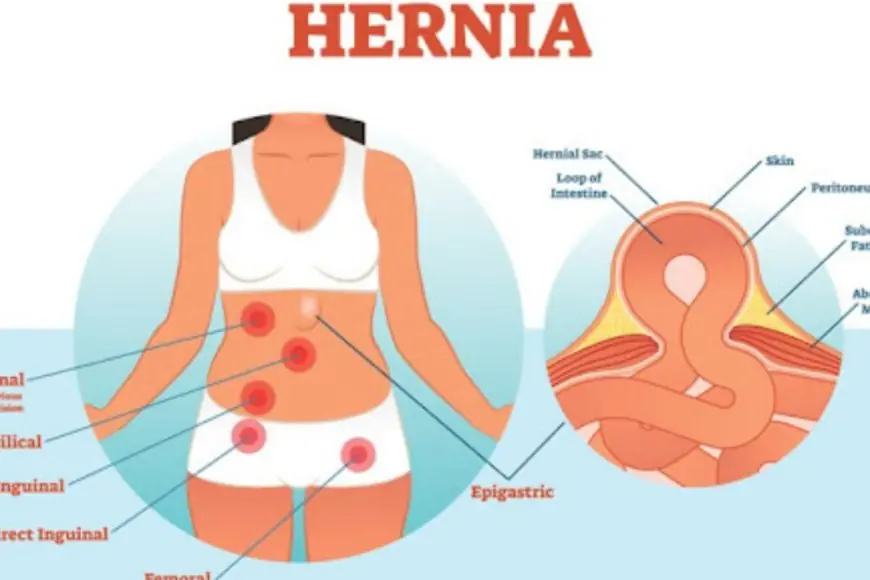 Hernia FAQs: Everything You Need to Know