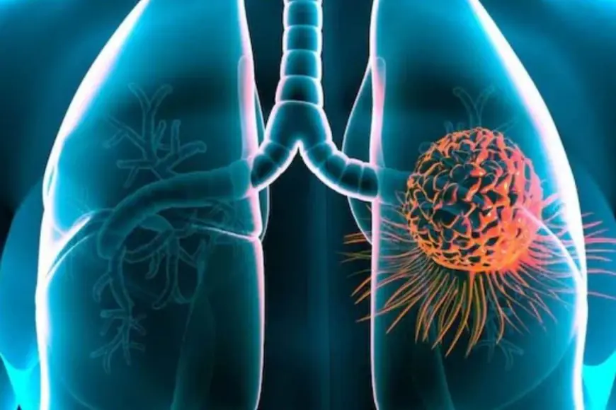 Coping With A Lung Cancer Diagnosis? What Every Indian Patient Needs to Know