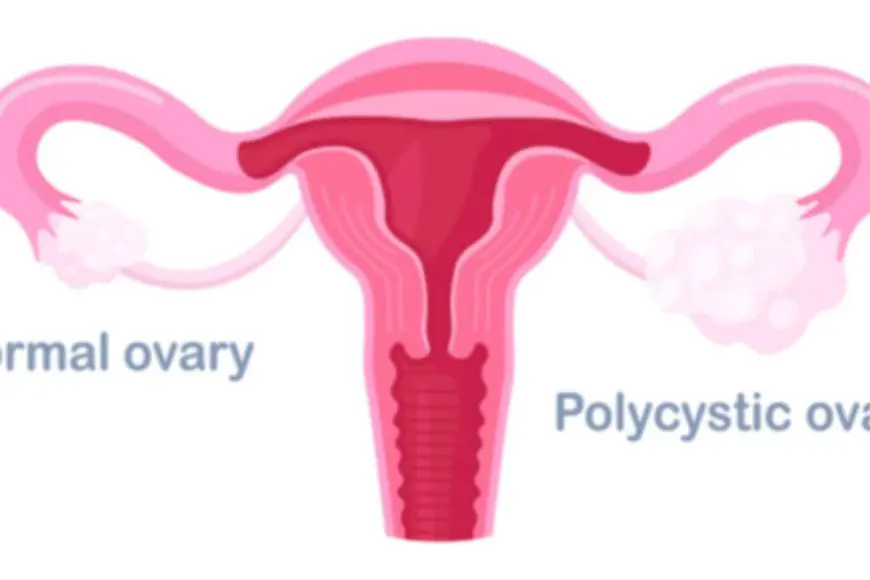 The Connection Between PCOS and Thyroid Disorders