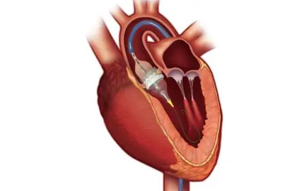 Beyond Blockages: Structural Heart Disease and the Rise of Minimally Invasive Solutions
