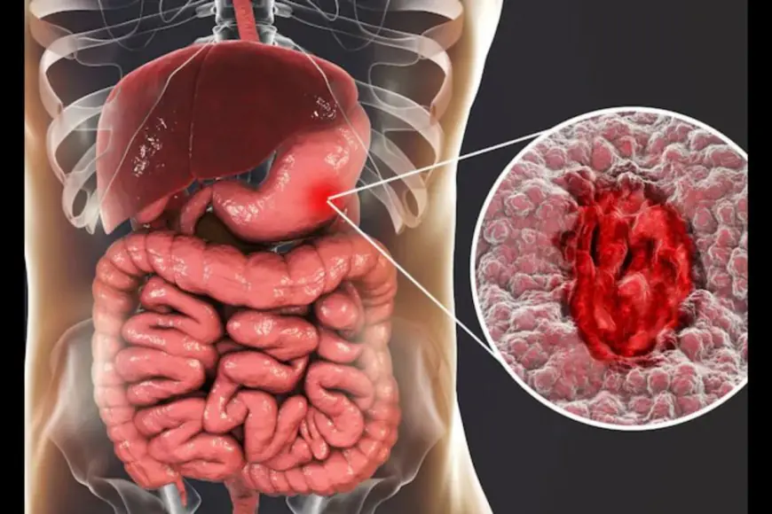 Your Gut Could Be In Danger: How Common Painkillers Are Silently Damaging Your Intestines