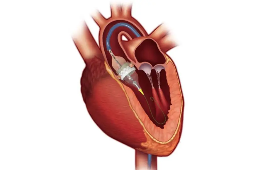 Beyond Blockages: Structural Heart Disease and the Rise of Minimally Invasive Solutions