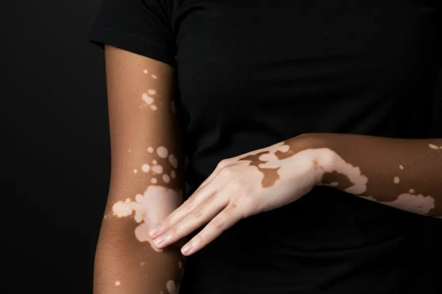 Why Vitiligo Patients Face A Mental Health Crisis, Not Just A Skin Condition