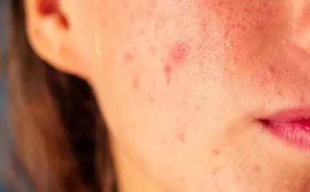 Body Acne In Rainy Season? Here’s How To Deal With It
