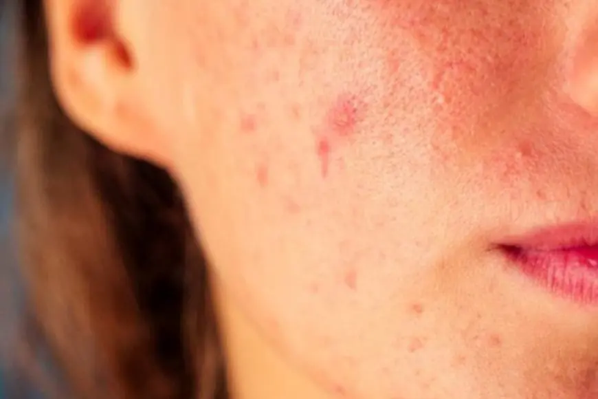 Body Acne In Rainy Season? Here’s How To Deal With It