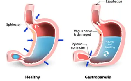 Myths Buster: 8 Beliefs About Gastroparesis And Why They Are Wrong… No, It’s Not Just ‘Gas’