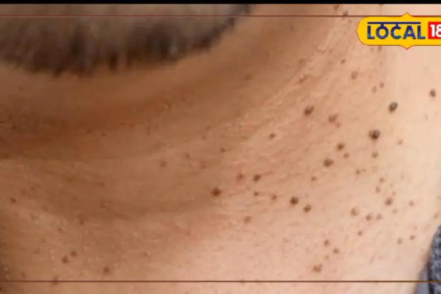 Unwanted Warts On The Body? Try This Remedy And See Them Fall Off Overnight