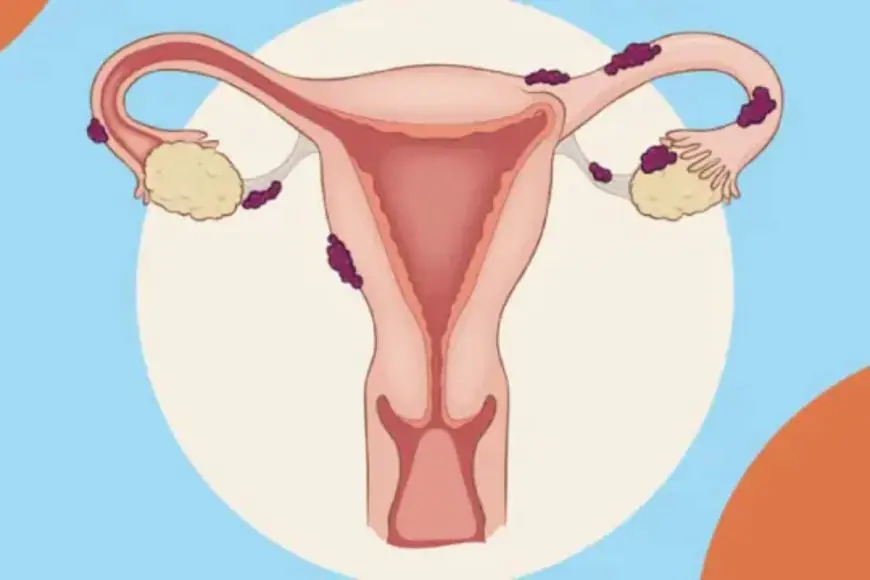 Endometriosis: Separating Myths From Facts