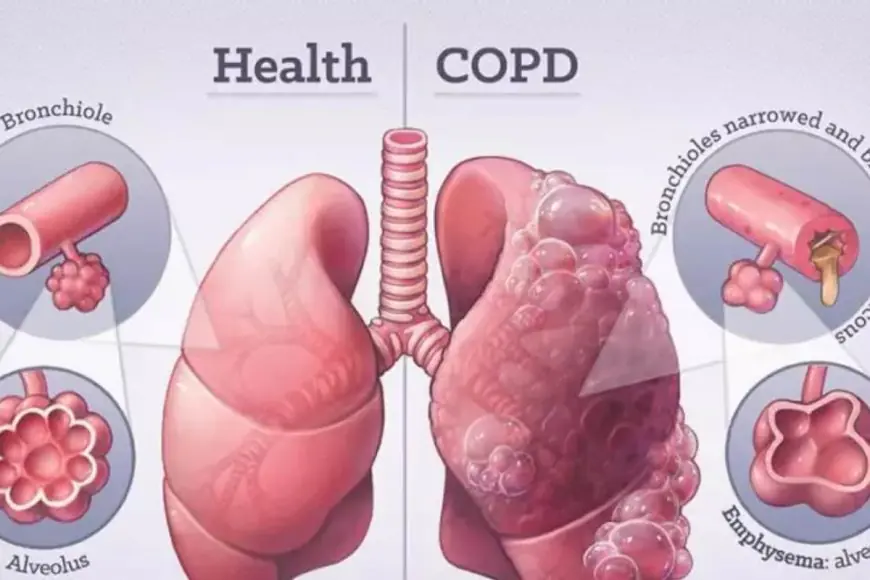 Why Winter Air Is Especially Dangerous For COPD Patients: Experts Explain The Hidden Triggers