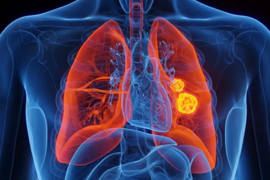 Symptoms That Don’t Seem Like Lung Cancer But Actually Are