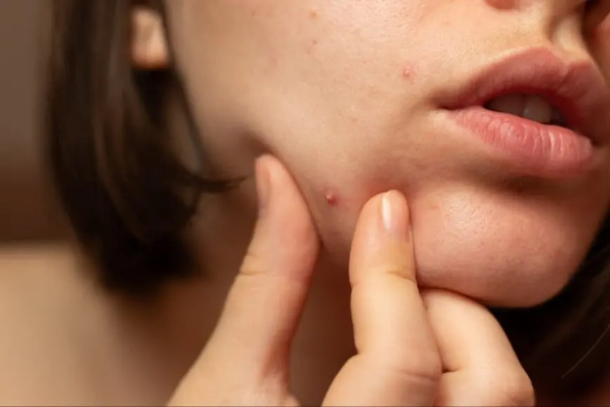 Beyond Teenage Pimples: How Stress And Lifestyle Are Fueling Acne In Young Indians