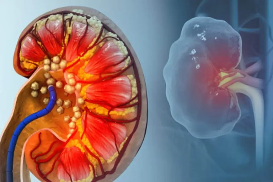 Suffering From Kidney Stones? Signs, Causes And Simple Steps That Can Ease The Pain