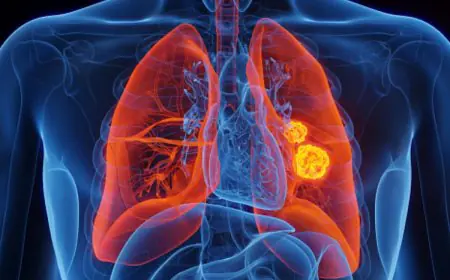 The Changing Face Of Lung Cancer: Why Non-Smokers Need To Be Vigilant