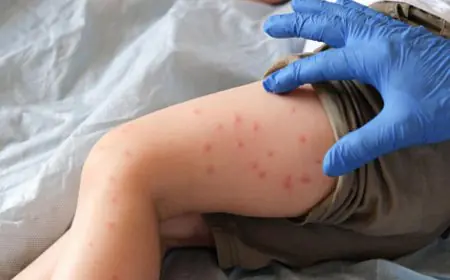 With World’s Richest Economies Losing Measles-Free Status, Can India Hit Its 2026 Elimination Goal?