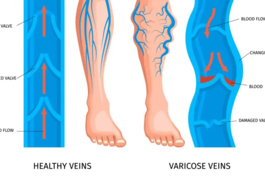 Varicose Veins: Understanding A Common Condition Beyond The Fear