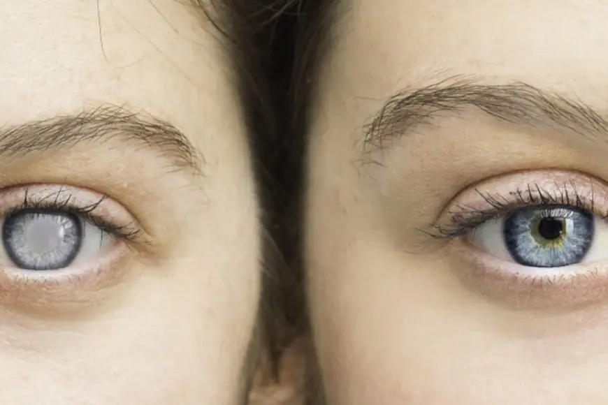 Young Adults Are Being Diagnosed with Glaucoma: What Are The Factor Behind It?