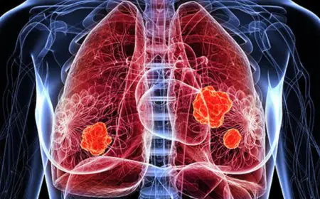 Lung Cancer: 10 Early Signs That Need Immediate Attention And Should Not Be Ignored