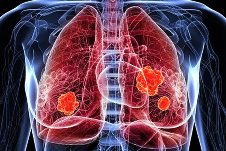 Lung Cancer: 10 Early Signs That Need Immediate Attention And Should Not Be Ignored