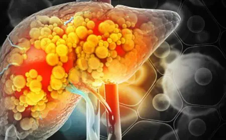 Can Fatty Liver Be Reversed? Doctors Share Tests And Key Lifestyle Tips